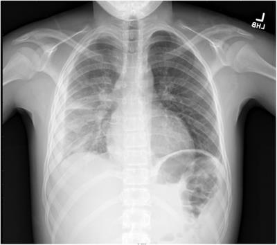 Case Report: Hypocomplementemic urticarial vasculitis syndrome in a pediatric patient with complement factor 1 deficiency